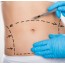 Tummy Tuck