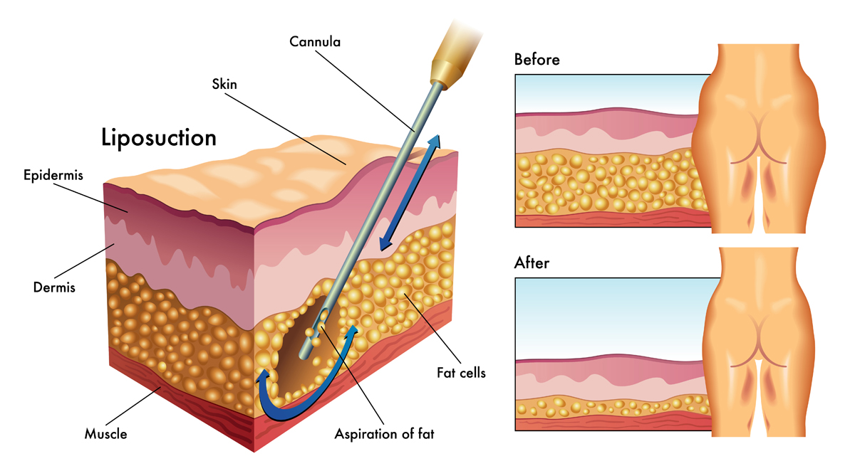 Liposuction - How it does work to extract fat