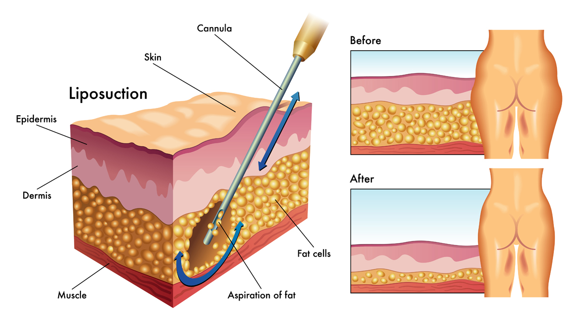 Liposuction - How it does work to extract fat