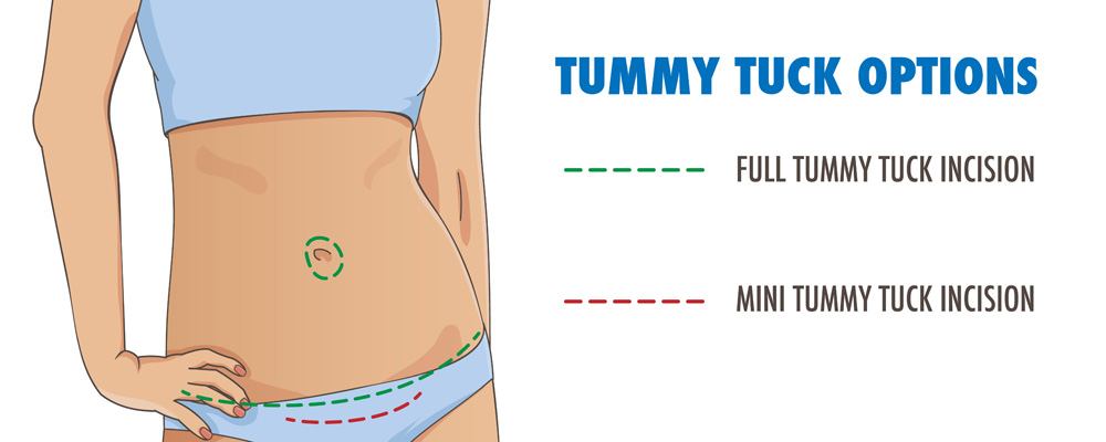 Tummy Tuck: Full vs Mini Full Tummy Tuck vs Mini Tummy Tuck