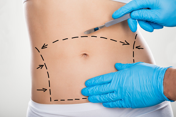 Tummy Tuck - What is it and how does it work?