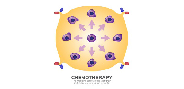 What's Chemotherapy Treatment?